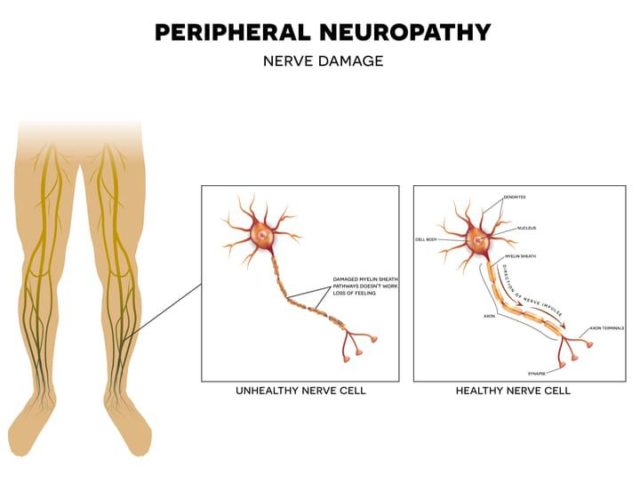 nerve damage - a healthy nerve cell vs a damaged nerve cell