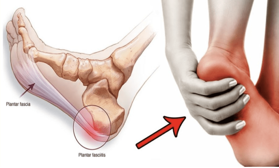 Heel Pain - Plantar Fasciitis - Causes, Symptoms & Treatment Options