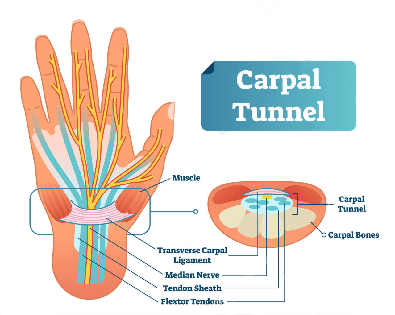 Using A TENS Unit For Carpal Tunnel – Is It The Best Option?