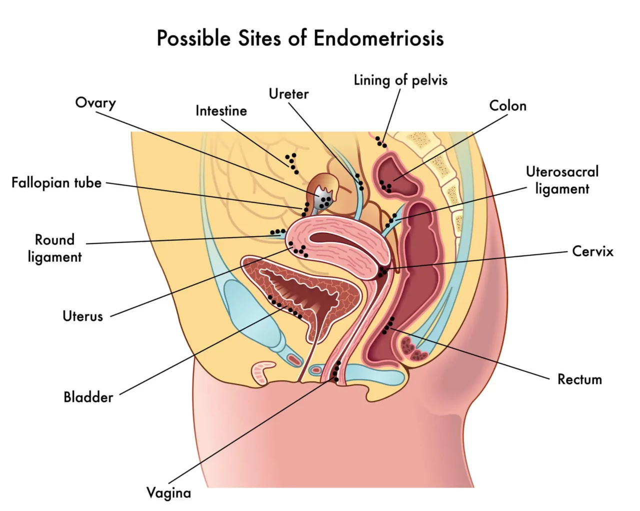 Identifying Endometriosis Scarring Symptoms
