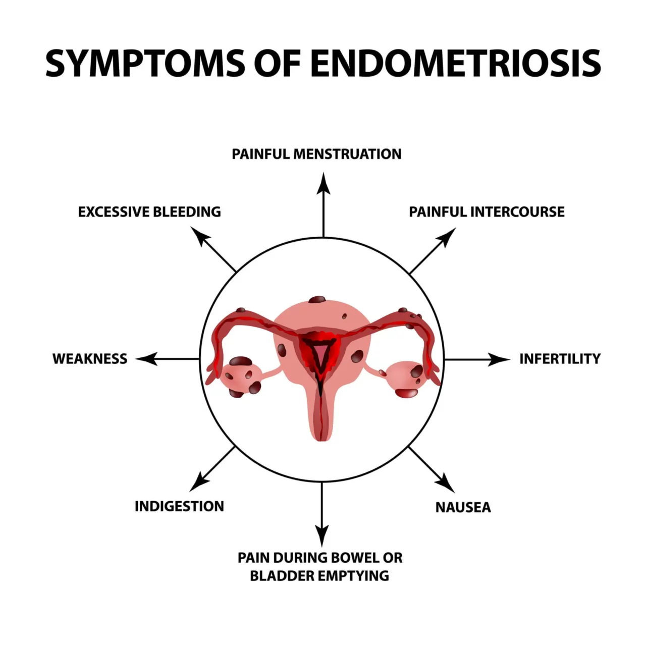 Endometriosis: Causes, Symptoms, Treatments, & More - Neuragenex