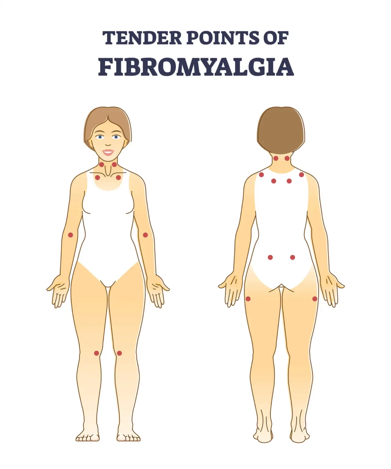 Fibromyalgia – The Complete Injury Guide - Vive Health