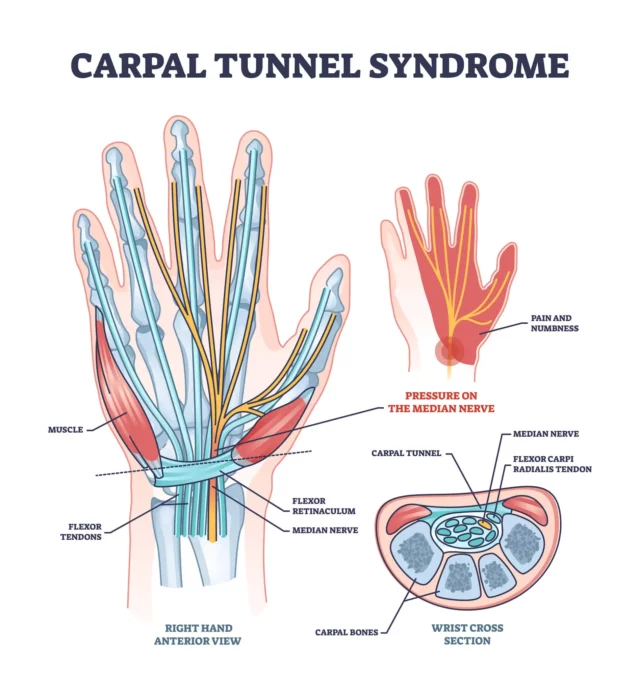 Nerve Compression Syndromes of the Hand: Overview, Anatomy