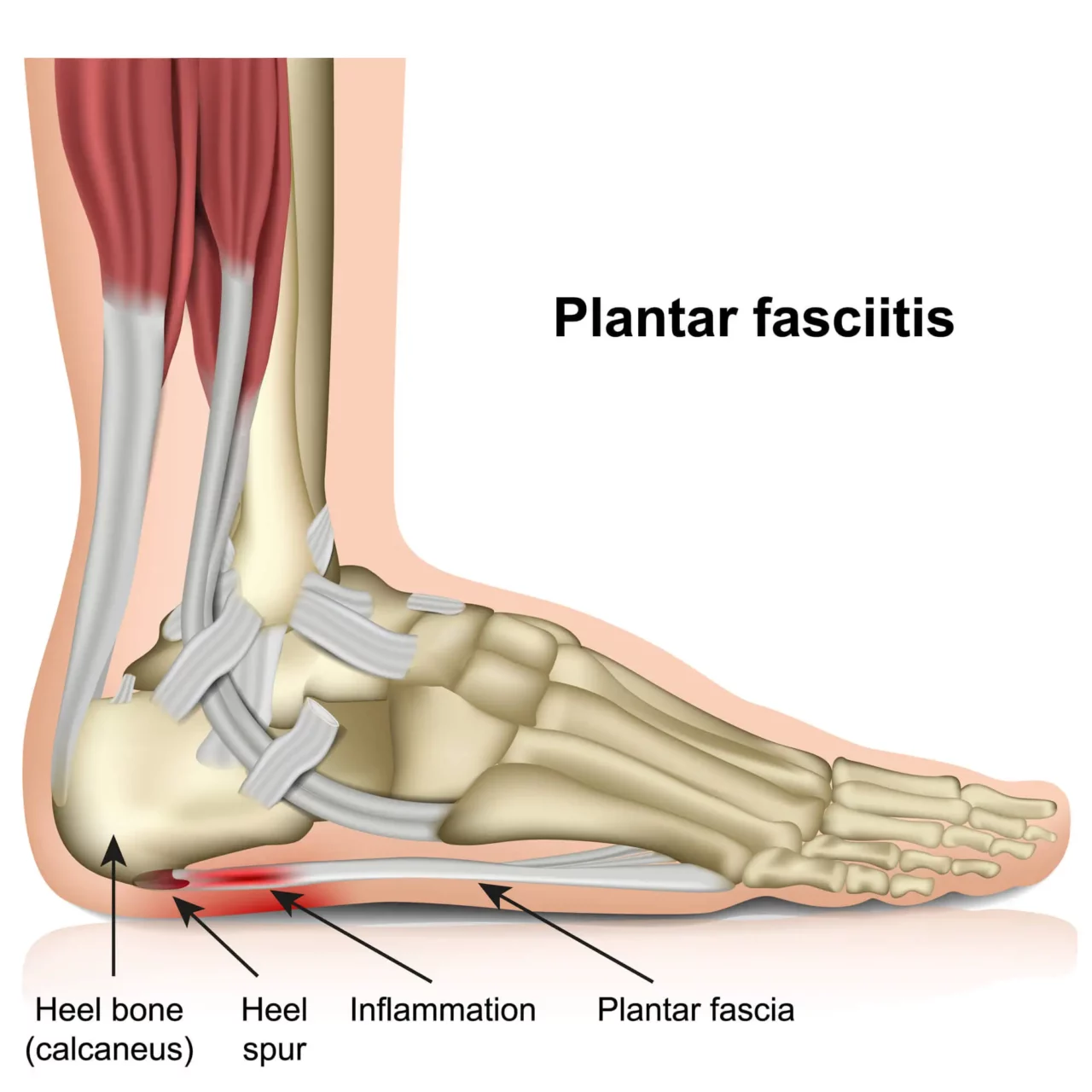 How Electrical Stimulation For Plantar Fasciitis Works