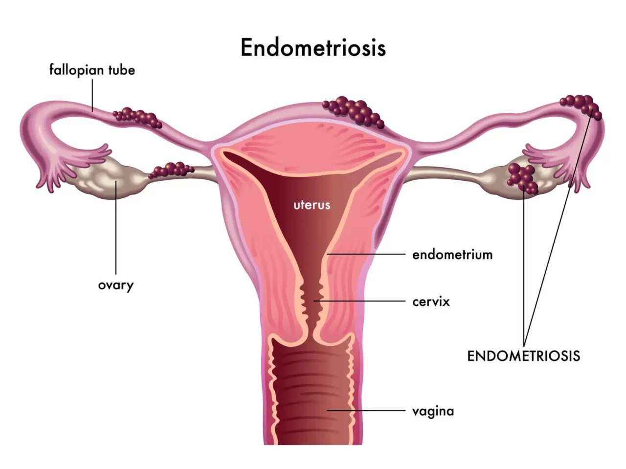 Endometriosis Symptoms: Flares, Periods, During Sex