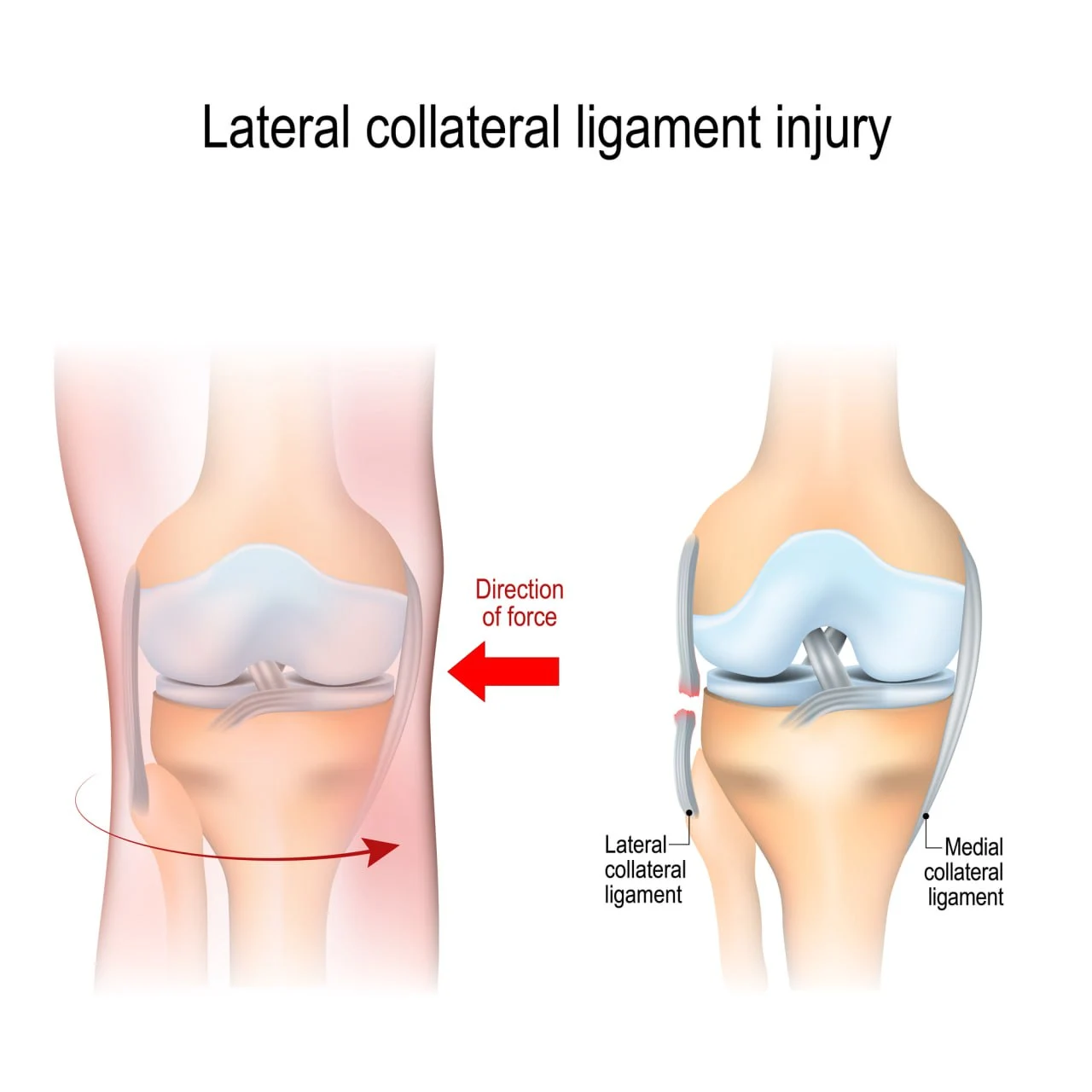 Collateral Ligament Pain In The Knee - Neuragenex
