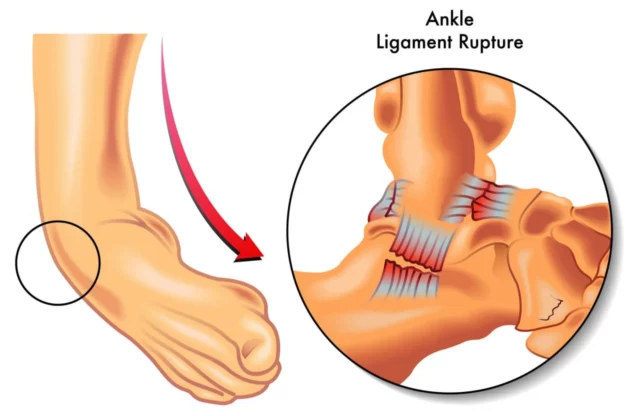 https://neuragenex.com/wp-content/uploads/2023/07/ankle-ligament-rupture-640x416.webp