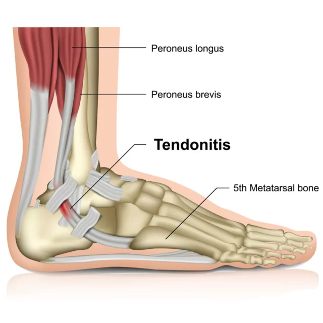 Heel Pain & Heel Fractures | Foot & Ankle Specialists | Bellevue