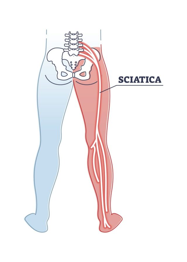 https://neuragenex.com/wp-content/uploads/2023/10/Sciatica-pain-or-nerve-weakness-as-leg-lumbar-radiculopathy-outline-diagram-640x896.jpg