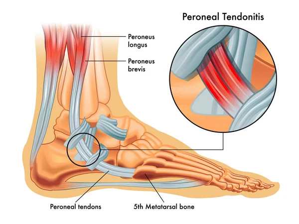 Ankle Impingement - Physiopedia